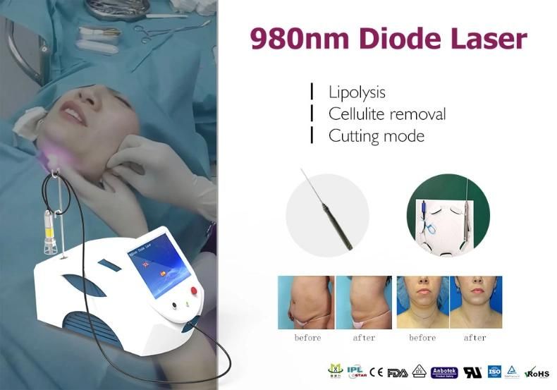 Laser Lipolysis Fat Loss Liposuction Endolifting 980nm Diode Laser Machine