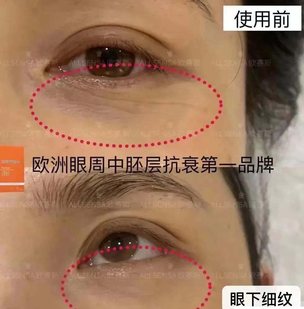 Allsensa Eyes Skin Booster Dark Circles Under The Eyes Bags Fine Lines Anti-Aging Eye Antioxidants Reduce Fine Lines Dermal Filler Injection Products Solutions