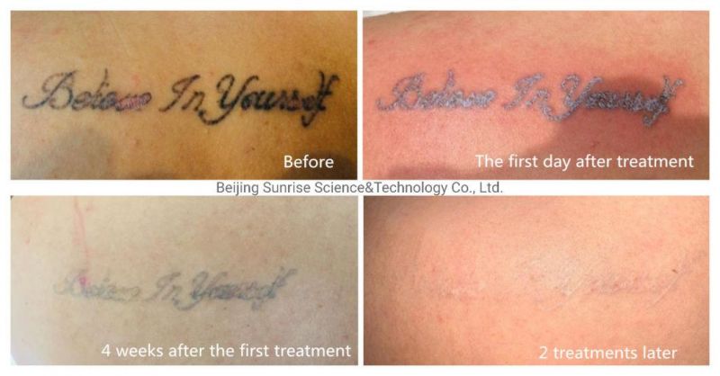 2022 Beijing Sunrise Multifunctional 2 in 1 ND YAG Laser Tattoo Removal Machines Elight Opt Shr IPL Hair Removal 1320 ND YAG Laser Carbon Peeling Skin Whitening