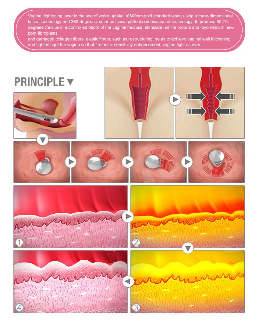 Manufacturer CE Approved Portable CO2 Fractional Laser Vaginal Rejuvenation Machine