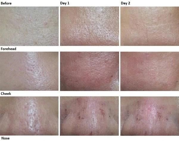 Fractional Laser CO2 Laser Skin Care Vagina Tightener Resurfacing