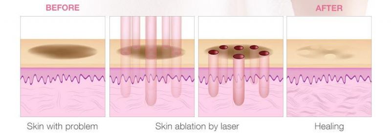 Manufacturer CE Approved Portable CO2 Fractional Laser Vaginal Rejuvenation Machine