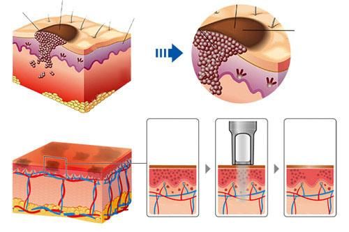 ND YAG Laser Tattoo Removalpigment Deposit Machine