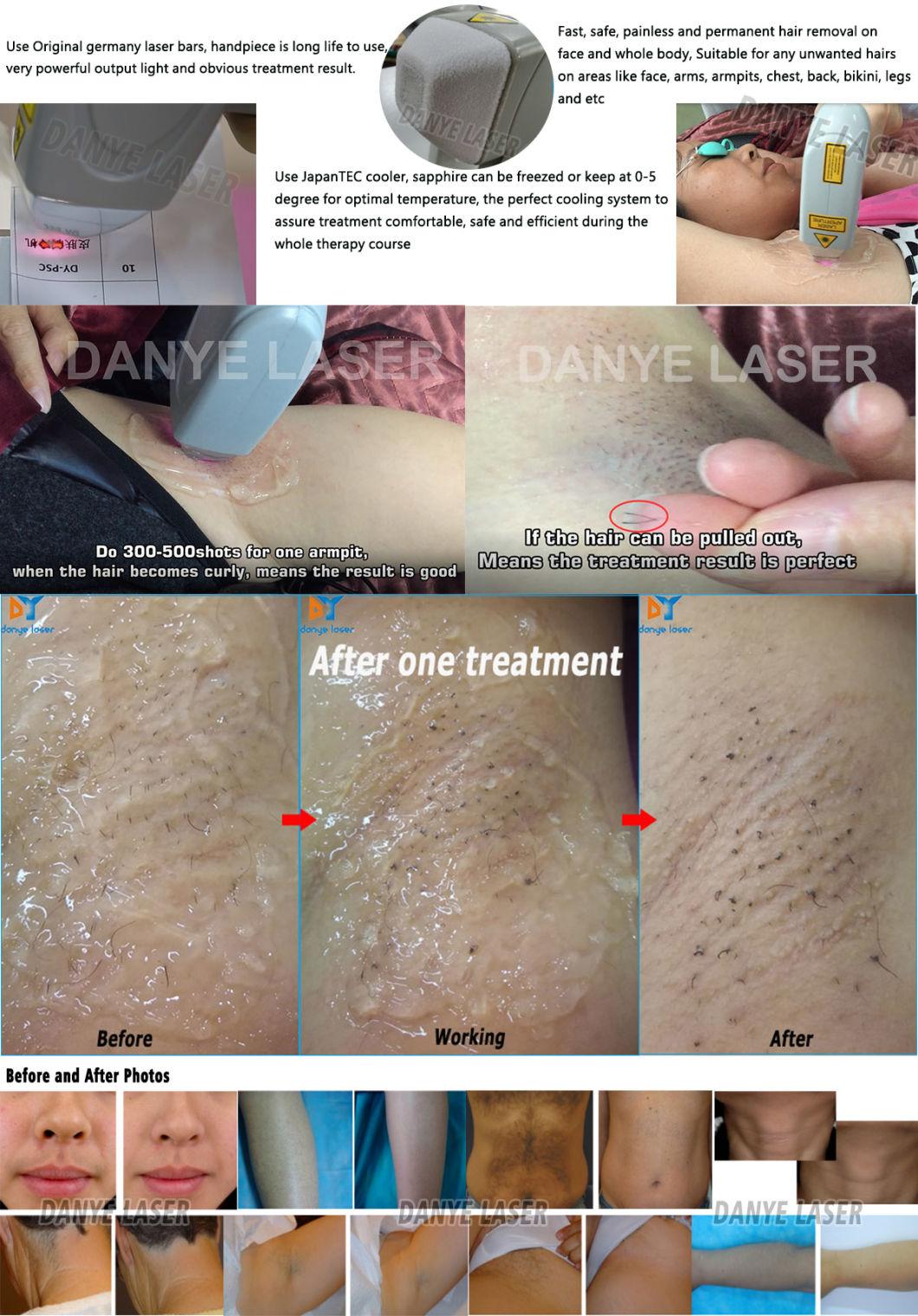 High Power 808 810 755 1064 Alexandrite Combined Trios Laser Hair Removal with CE RoHS