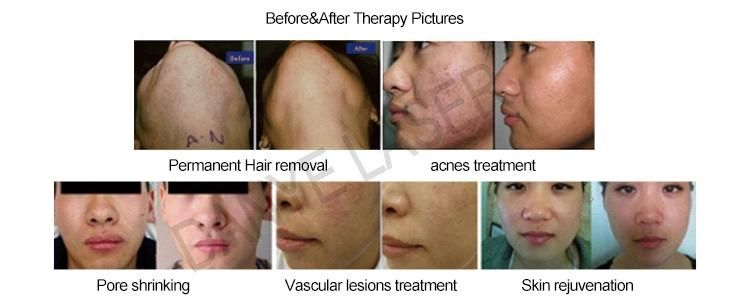 Dpl Hair Removal and Whitening Skin Laser Beauty Machine for Skin Rejuvenation