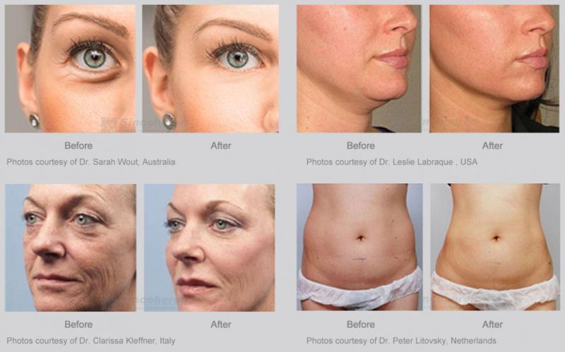 Sincoheren 2021 Hot Selling 7D Hifu Ultrasound Face Lift and Wrinkle Removal Device Vaginal Tightening