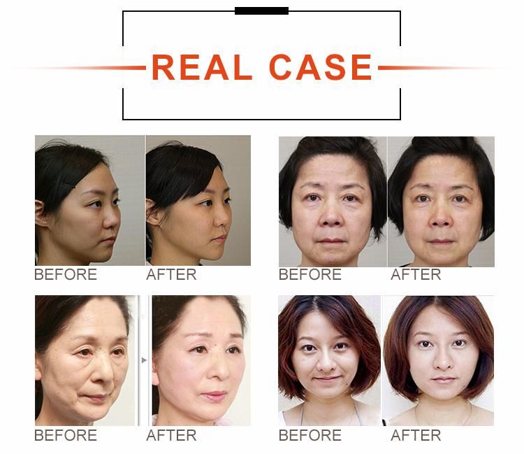 Ultrasound Conductive Technique Hifu Anti-Aging Facial Beauty Equipment