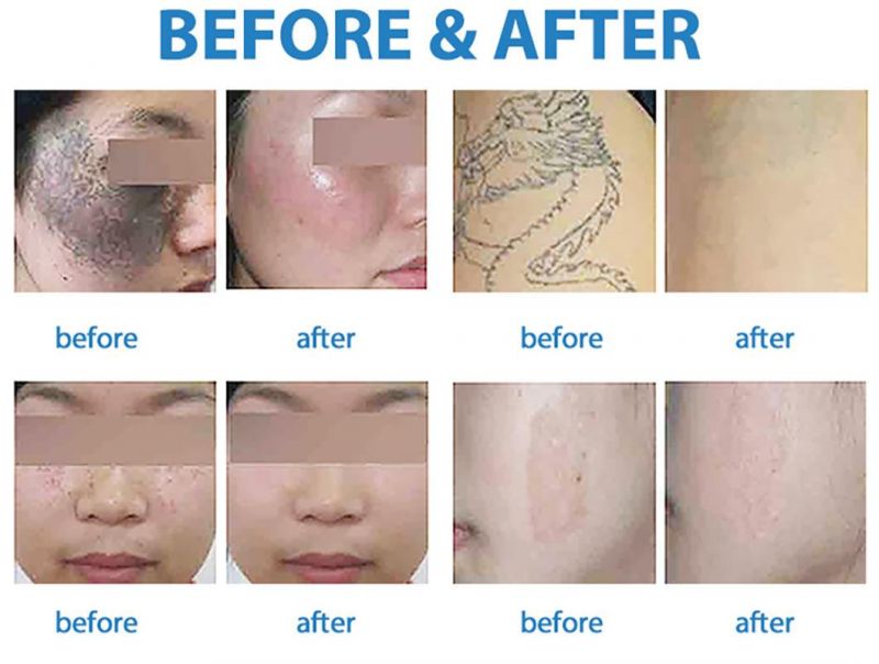 Laser Tattoo Removal Machine Uses The Blasting Effect of Laser. The Laser Effectively Penetrates The Epidermis and Can Reach The Pigment Clusters in The Dermis