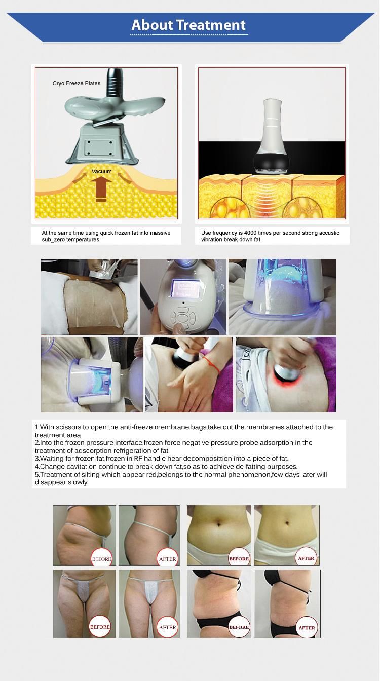 Hot Portable Cryolypolysis Vacuum Weight Loss