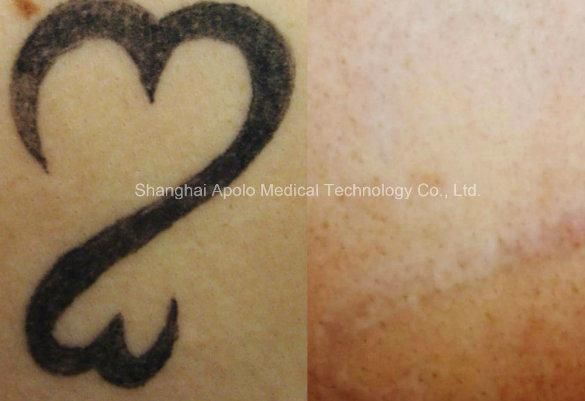 Pigments Removal Equipment Best Q-Switch ND YAG Laser for Tattoo Removal and Pigment Treatment