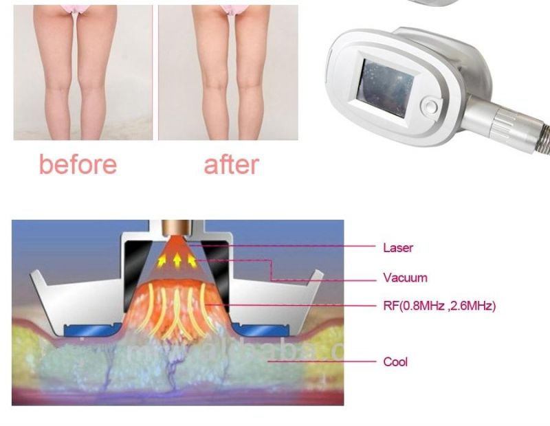 Body Shape Skin Care High Frequency Vacuum RF Freeze Fat Slimming Beauty Machine (CRV6/CE)