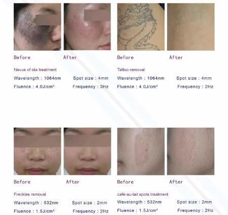 Q Switch ND YAG Laser Permanent Tattoo Removal and Eyebrow Laser Tattoo Removal