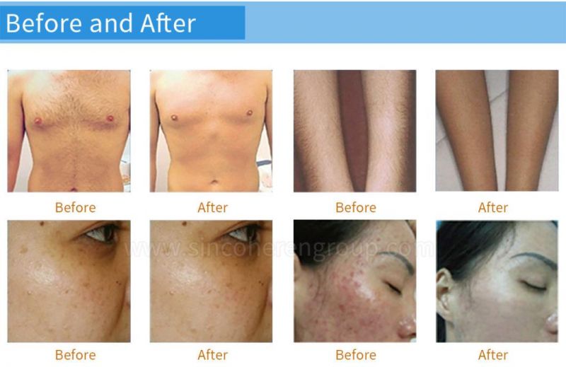 Az FDA Approved IPL Hair Removal Skin Rejuvenation Removing Acne