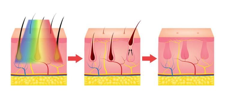 Water Air Semiconductor Cooling System 3 in 1 IPL RF Laser Hair Removal Machine