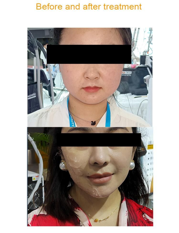 2022 New Professional Skin Rejuvenation 7D Hifu Beauty Machine