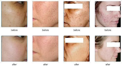 New Professional IPL Elight Machine for Hair Removal and Skin Care