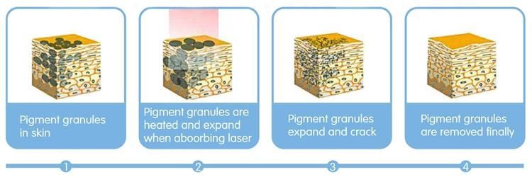 ND YAG Tatto Laser and Pigment Remove Q Switch ND YAG Laser Tattoo Removal 1064 532nm Laser