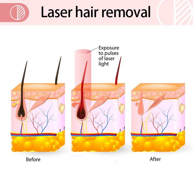 808nm Diode Laser Hair Removal Medical Machine