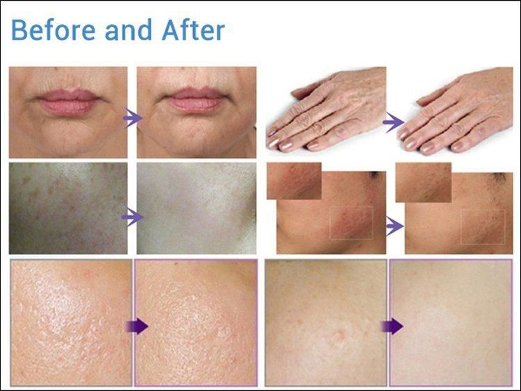 Hydra Wrinkle Removal Therapy Hot New Product in 2022 ADSS Grupo