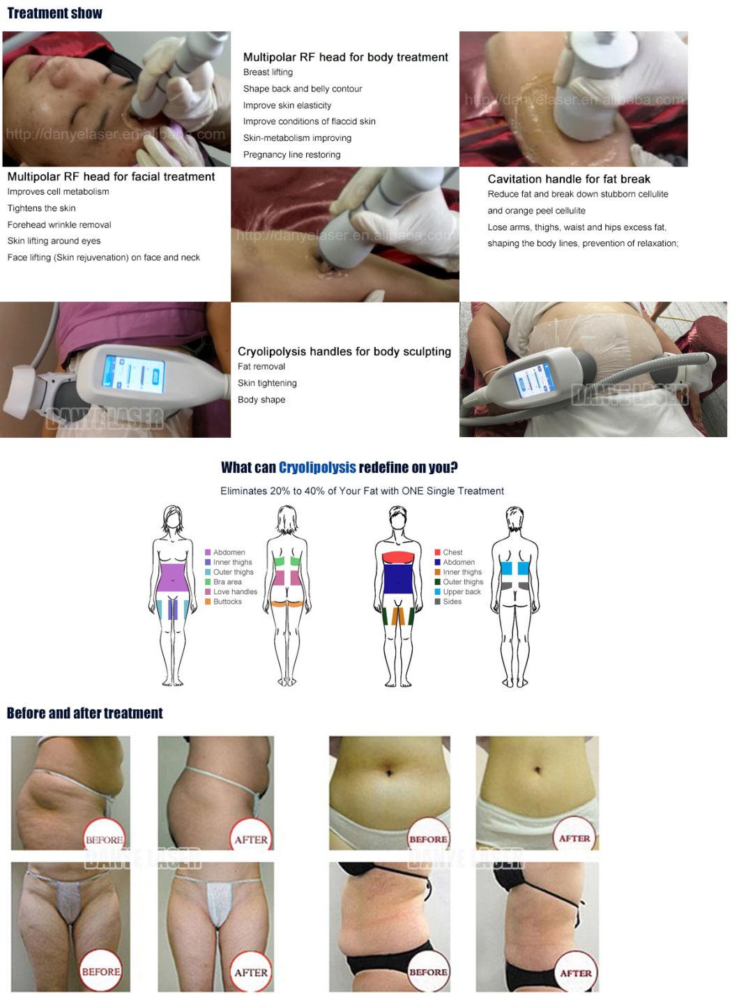 Newest Technology 360 Full-Side Cooling Cryolipolysis Slimming Machine with Double Cryo Handles -20 Degree for Sale