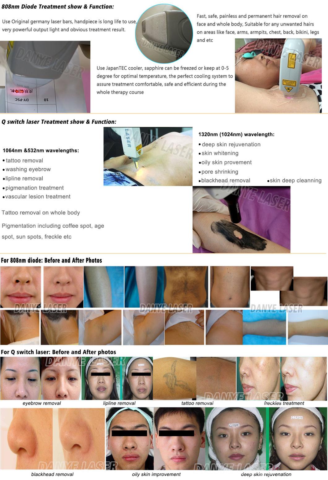 808 1064 532 Diode Q Switched ND YAG Laser Hair Removal Tattoo Removal Advanced Technology Laser Company