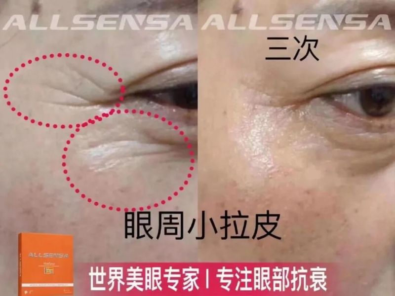 Allsensa Eyes Skin Booster Dark Circles Under The Eyes Bags Fine Lines Anti-Aging Eye Antioxidants Reduce Fine Lines Dermal Filler Injection Products Solutions