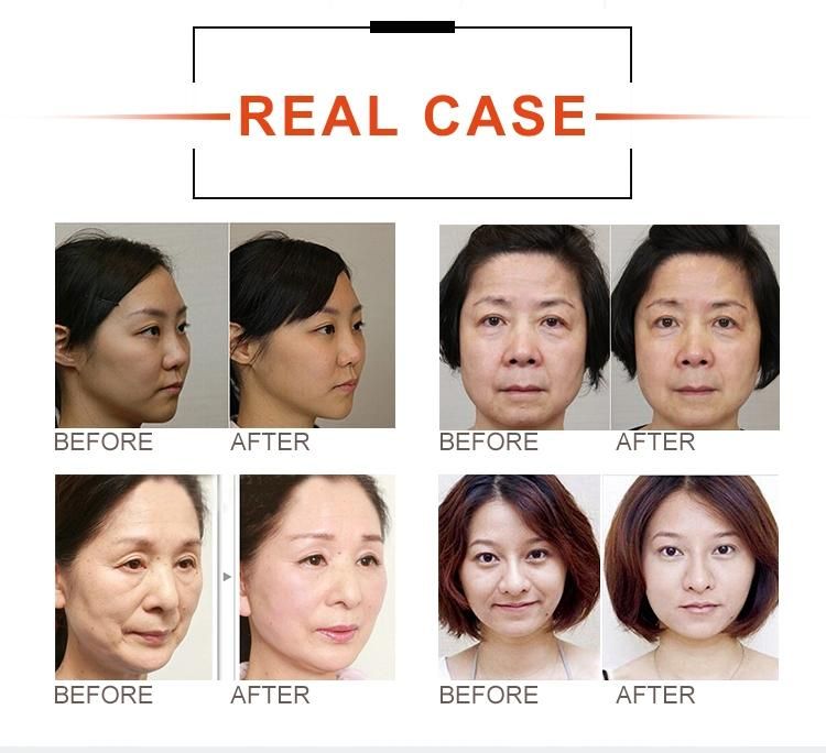 Ultrasonic 4D 11 Lines Anti-Aging Machine Hifu Face Lift Machine