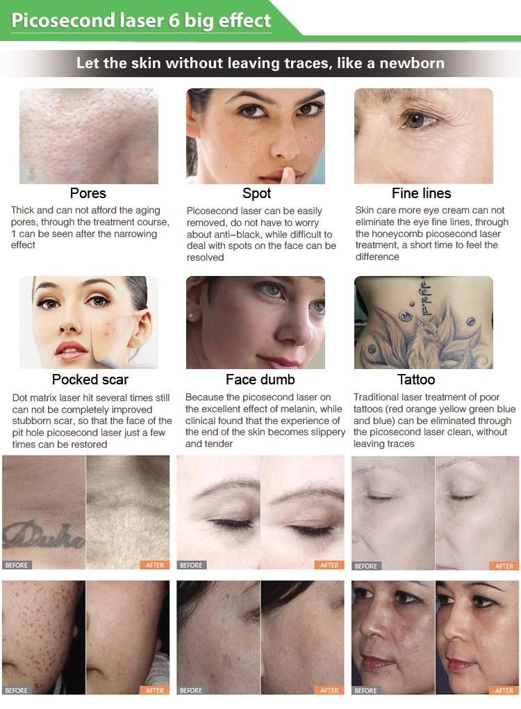 Picosecond Laser Tattoo Removal Skin Rejuvenation