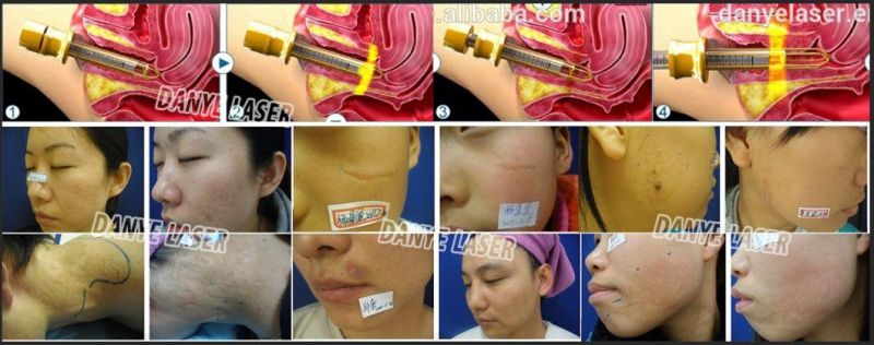 Medical Fractional Laser CO2 to Remove Scars Stretch Marks Skin Treatment Therapy