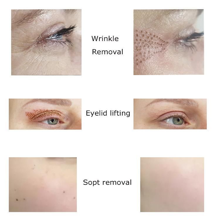 Eyelid Lifting Cautery Mole Spot Anti Wrinkle Removal Plasma Pen