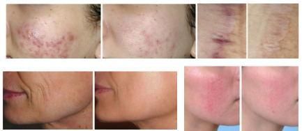 Scars Treatment & Laser Scar Removal Equipment