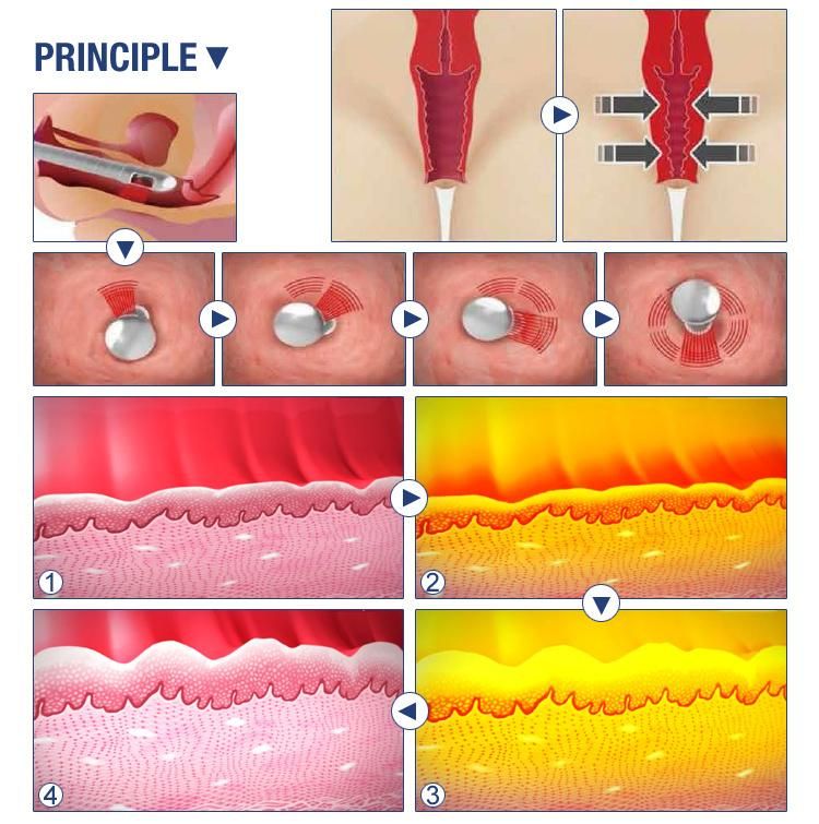 FDA Approved C02 Fractional Laser Beauty Machine for Skin Vaginal Resurfacing