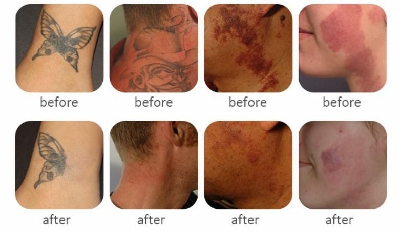 FDA Approved Picosecond Laser Tattoo Removal Machine 2020