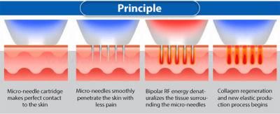 Safety Needles System Micro Needle Fractional RF Beauty Machine/RF Microneedle Fractional/Fractional RF