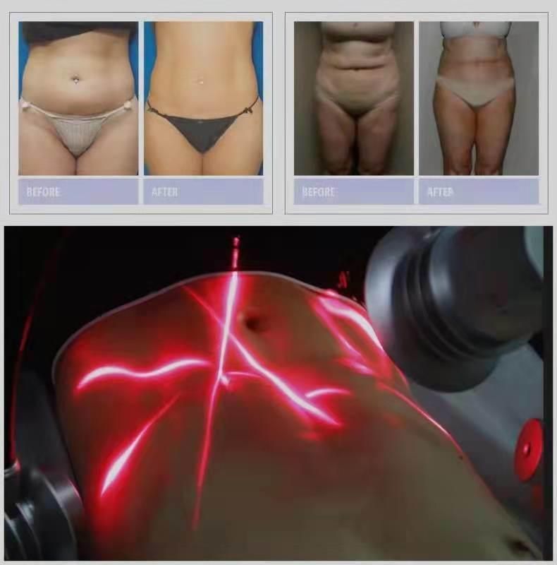 Fat Burning Cellulite Weight Loss Cold Laser Green Red Light 532nm 635nm Wavelength Body Shape 6D Slimming Machine Lipo Laser
