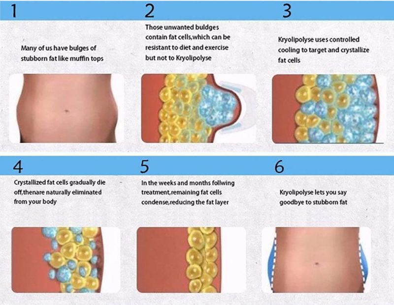 Germany Fat Freeze Most Effective Sincoheren Coolplas CE Approved Cryotherapy Cryo Fat Freezing Machine