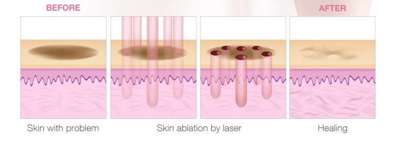 Beauty Equipment CO2 Skin Tightening Wrinkle Removal Fractional Laser
