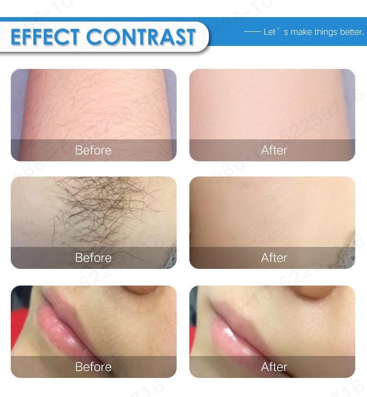 Professional Salon Equipment Skin Rejuvenation Skin Care Sdl-K Diode Laser Hair Removal Beauty Equipment