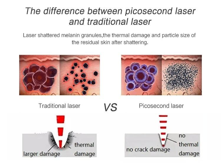 Carbon Peel Tattoo Removal Laser Machine ND YAG Laser