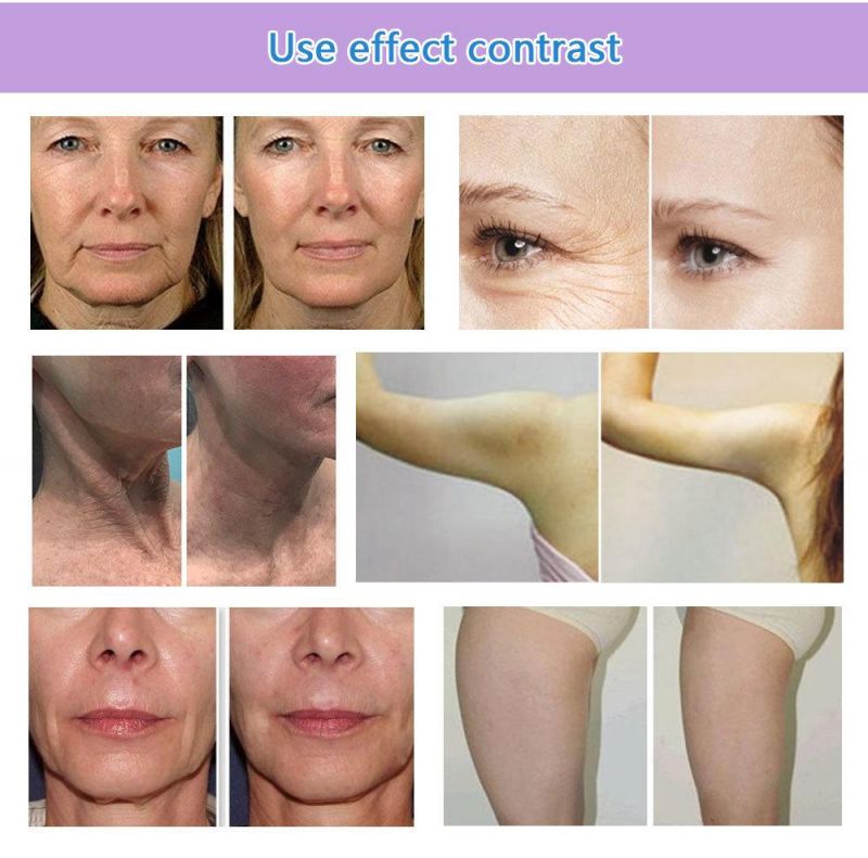 Face Lifting Device 7D Hifu Cartridge for Anti-Wrinkles