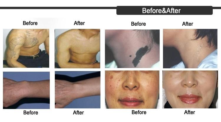 Acne Scars Removal Skin Rejuvenation Picosecond Laser