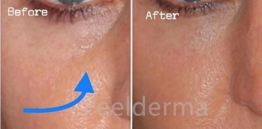 Long Lasting Hyaluronic Acid Serum 2ml Dermal Filler Hyaluron Pen Injector No Needle for Lips Wrinkles