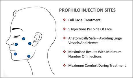 Cheap Price Profhilo H+L Before and After Photos Reviews Treatment Results High Pure Hyaluronic Acid 64 Mg/Ml in Stock