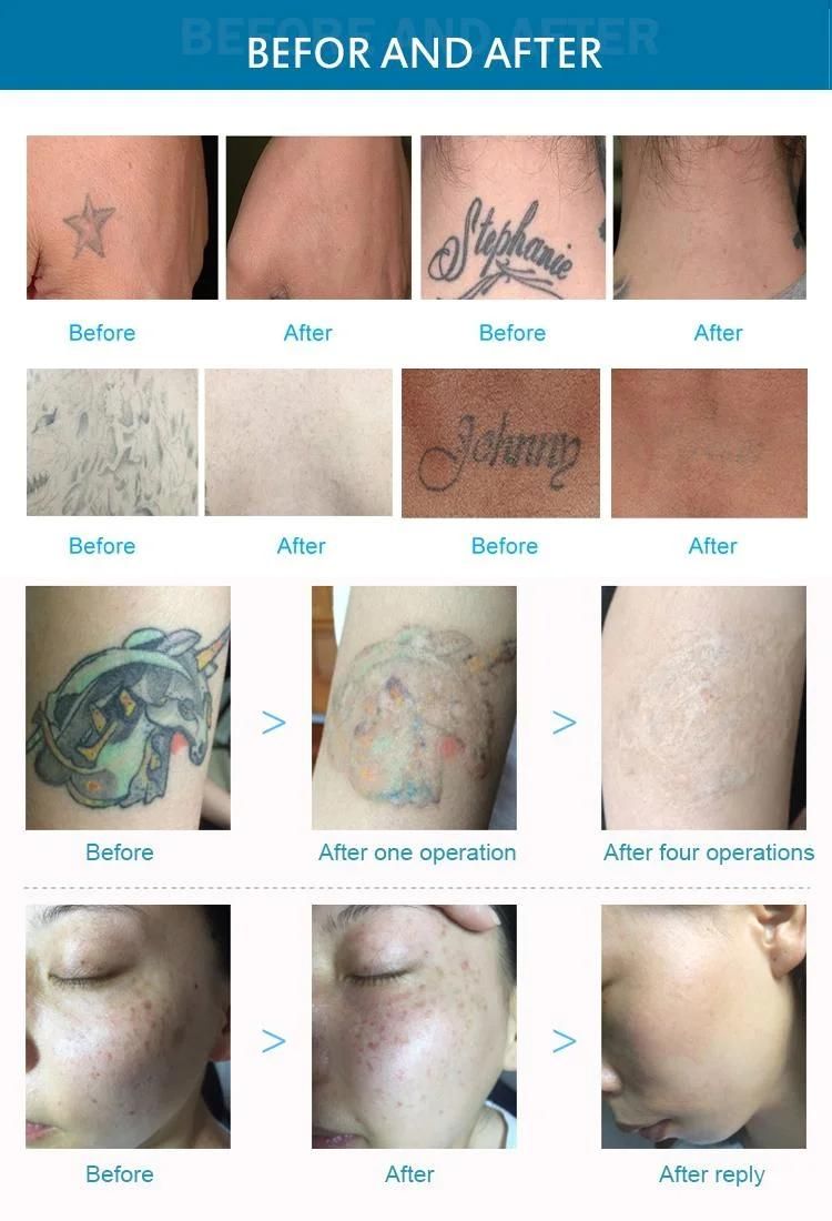 High Quality Q Switched Carbon Peel Tattoo Removal ND YAG Laser