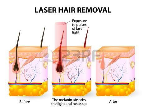 FDA Medical Ce 808nm Diode Laser Hair Removal Machine for Beauty Clinic