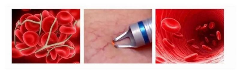 Vein Removal 980nm Diode Laser