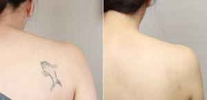Painless Aesthetic Laser Tattoo Removal and Skin Revitalization Treatment (S600)