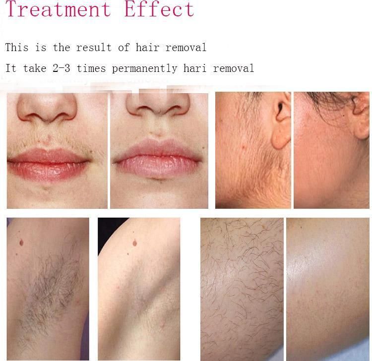 Perment Painless 808nm Diode Laser Hair Removal