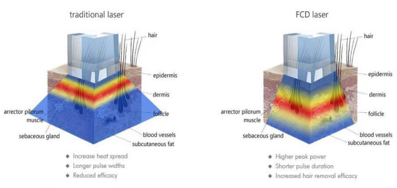 Sincoheren CE Approved 810nm Fiber Coupled Hair Removal Laser Machine