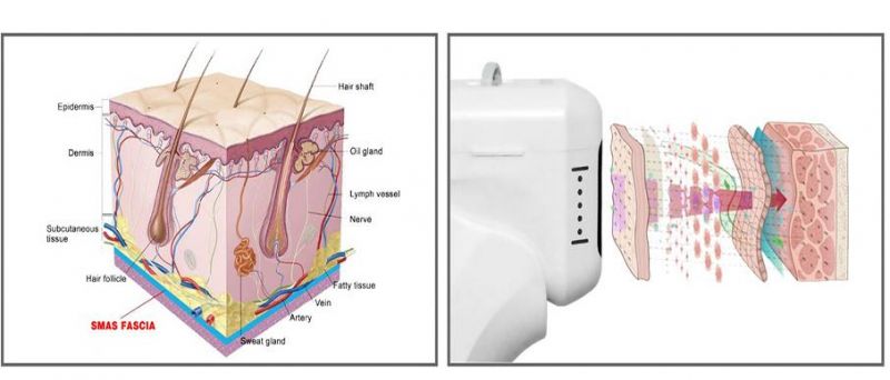 Sincoheren 5D Hifu 20000/60000 Shots Hifu 5D Focused Ultrasound Face Lift Portable Facial Lifting Machine